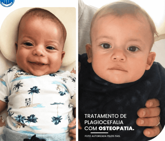 Atendimento de osteopatia pediátrica